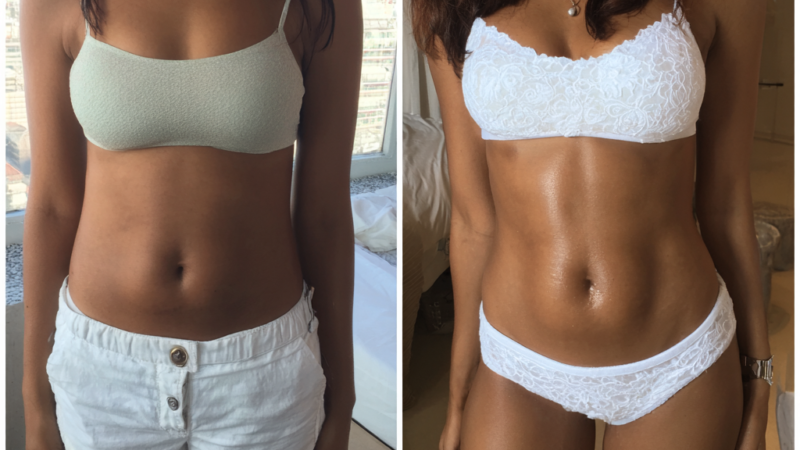 5 Tips for Maintaining Your Laser Lipo Results in Cape Town